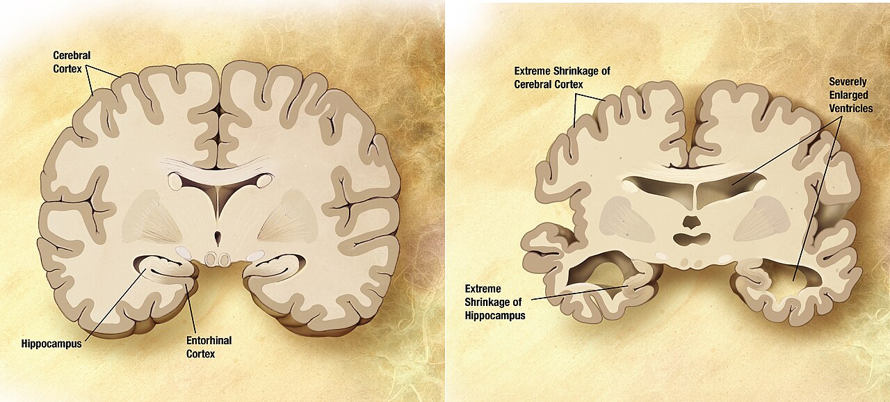 Healthy brain next to a brain with Alzheimer's