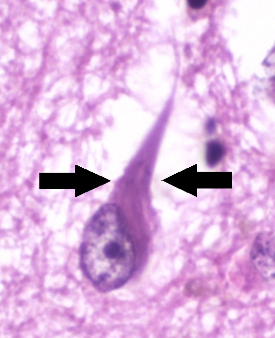 Real brain tissue under a microscope: the arrows point to a tau tangle inside a neuron.