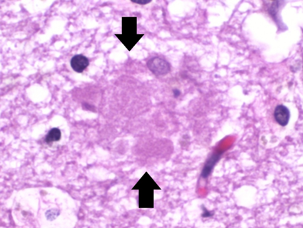 Microscope image of Alzheimer's brain tissue