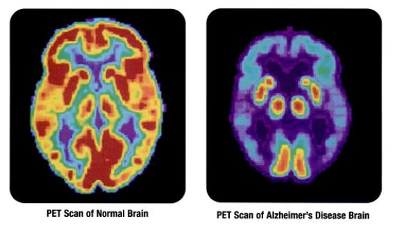 Brain scan showing Alzheimer's
