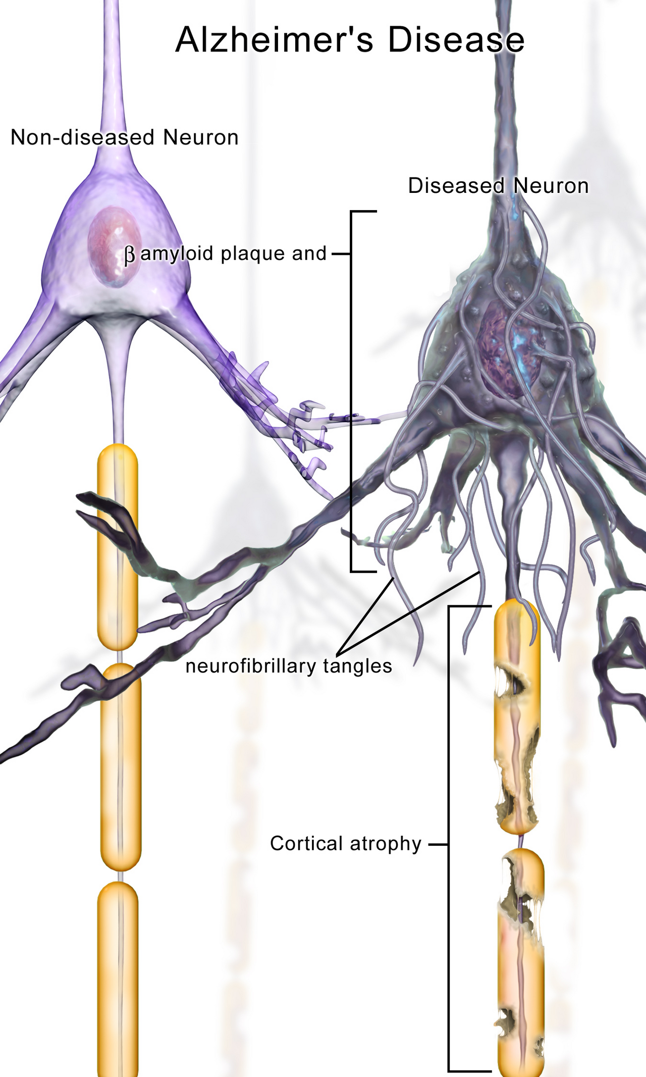 Plaques and tangles: the junk proteins that build up in Alzheimer's.